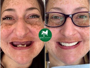 Before After Smile make over