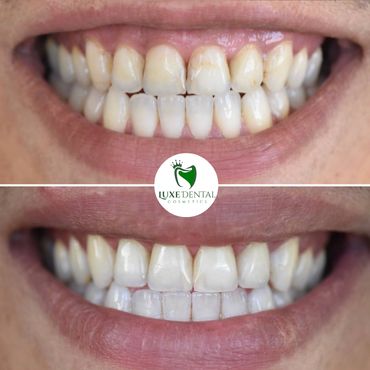 teeth whitening and composite veneers