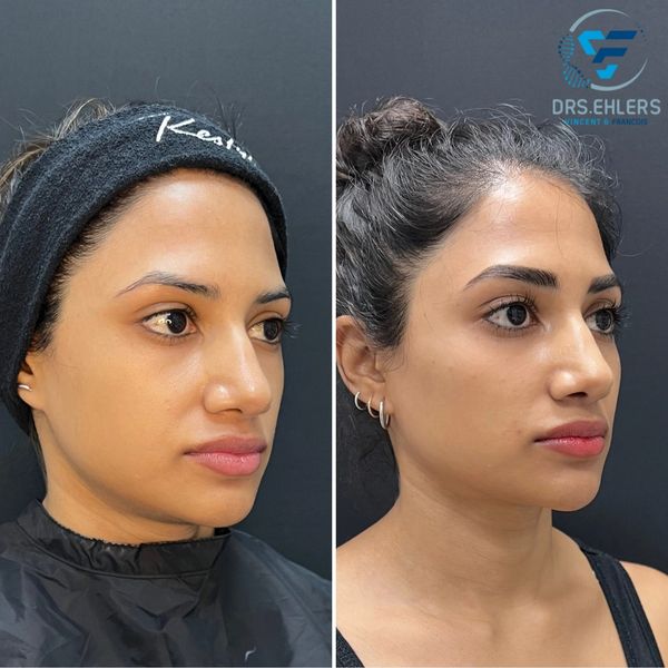 Profile balancing - chin and cheek enhancement with filler