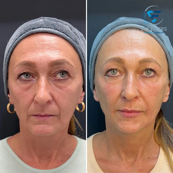 Full facial rejuvenation with dermal filler