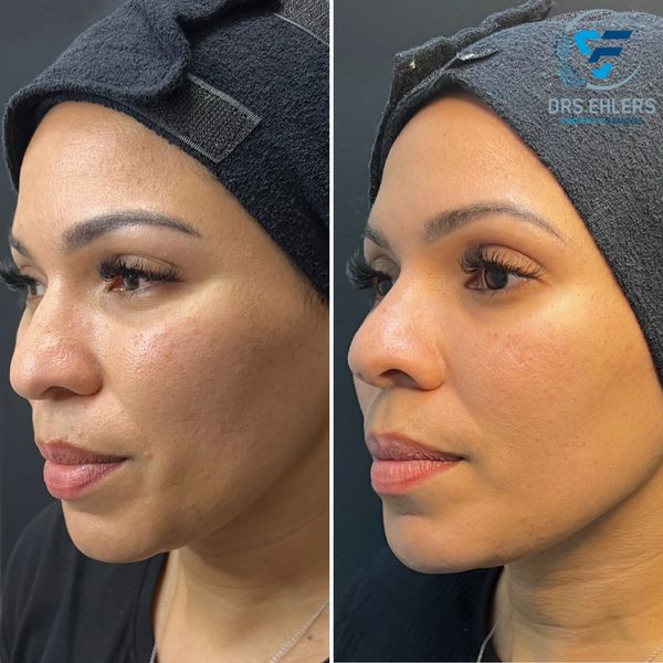 Nasal tip lift with thread rhinoplasty
