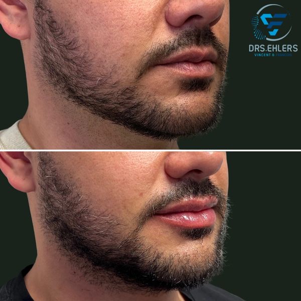 Male lip enhancement