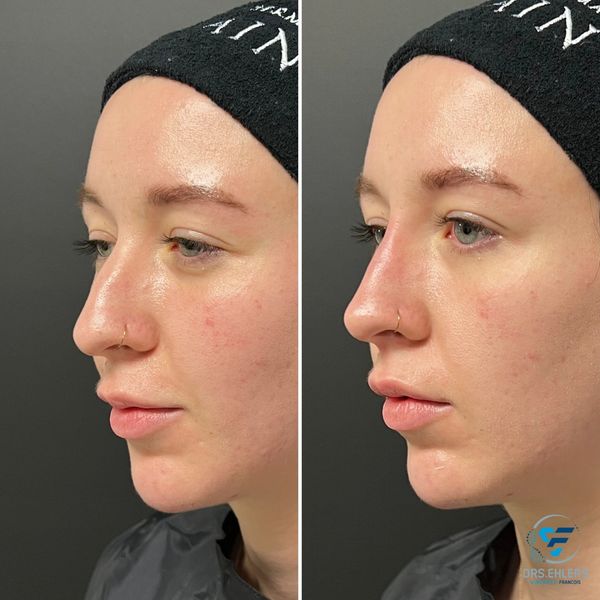 Non-surgical rhinoplasty nasal bridge and tip refinement