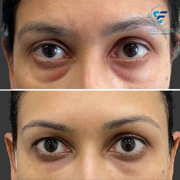 Under eye tear trough filler