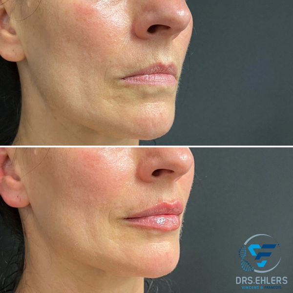 Lip enhancement with dermal filler