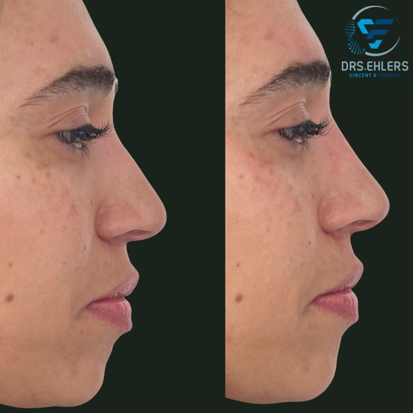 Non-surgical rhinoplasty - Nasal bridge refinement with dermal filler