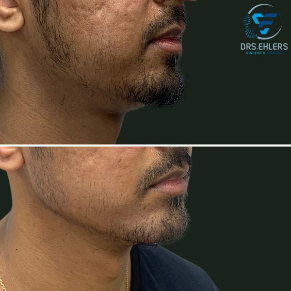 Jawline enhancement with dermal filler