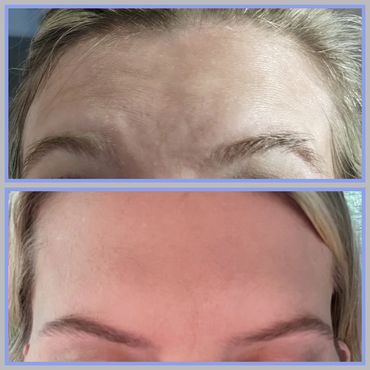 Botox Columbus Ga
Xeomin Columbus GA