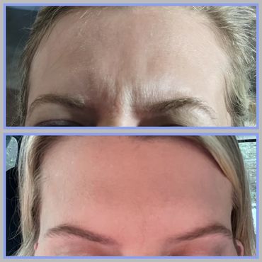 Botox Columbus GA