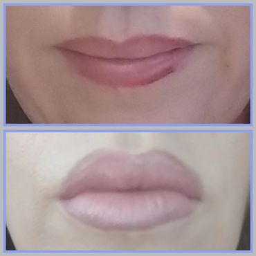 Lip Filler Columbus GA