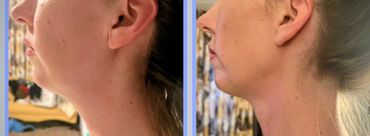 Kybella Columbus GA