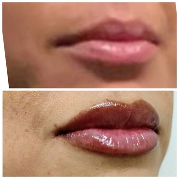 Lip filler Columbus GA