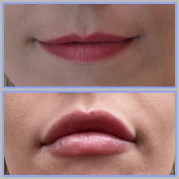 Lip Filler at Fountain Wellness and Aesthetics