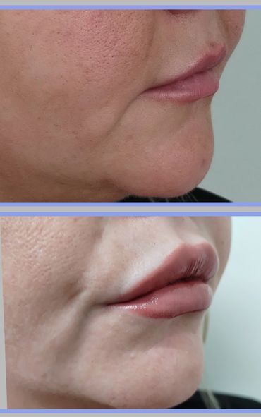 Lip Filler Columbus GA