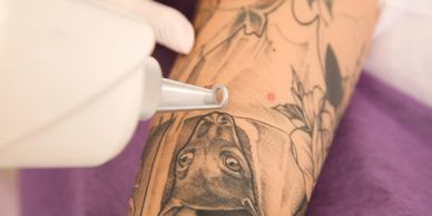 Procedimiento de eliminación de tatuajes en proceso, mostrando un dispositivo láser aplicado sobre un tatuaje en un brazo