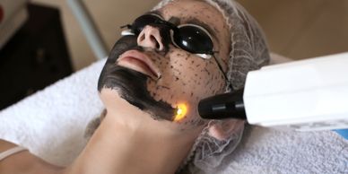 Procedimiento de láser facial sobre piel con tratamiento de carbón activado, con el paciente usando gafas de seguridad.