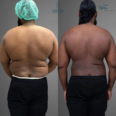 Male Liposuction 360