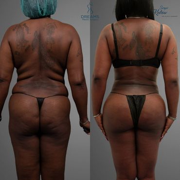 Liposuction 360 + BBL