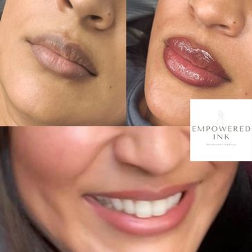 Lip neutralization is designed for individuals with dark or unevenly pigmented lips.