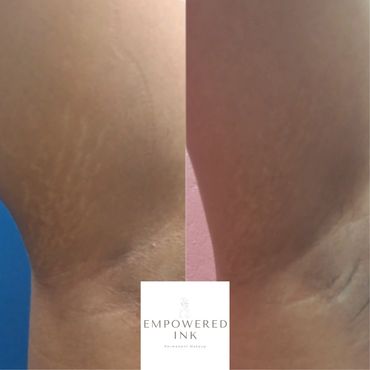 Stretch Mark Camouflage Training