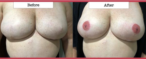 Before and after photos of 3D areola and nipple tattoos after reconstruction surgery.