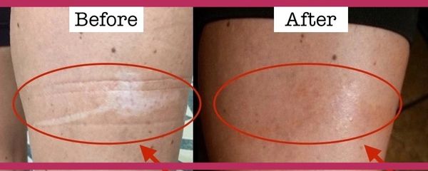 Before and after photos of a skin correction tattoo on a woman's leg.