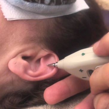 Auriculotherapy is a technique of using points on the skin of the auricle (external ear) to diagnose
