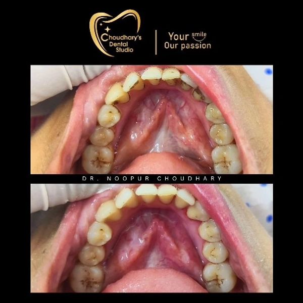 Before and after dental cleaning showing improved tooth cleanliness.