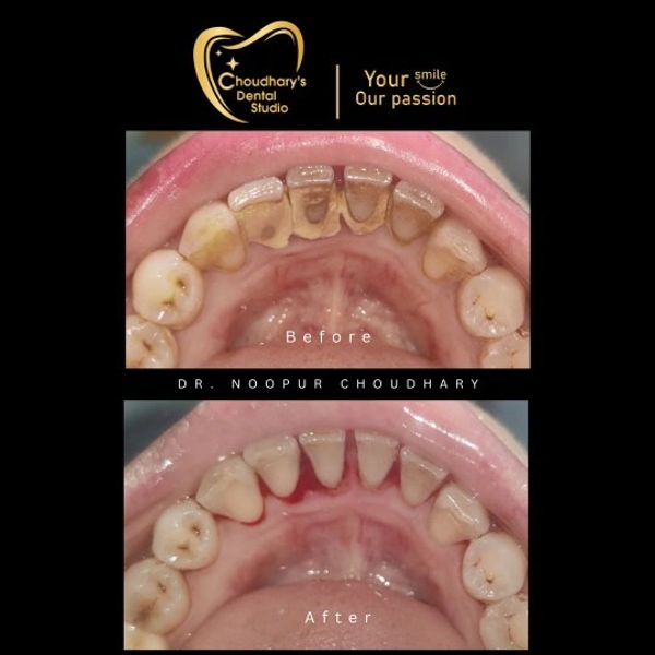 Before and after dental cleaning showing significant plaque removal.