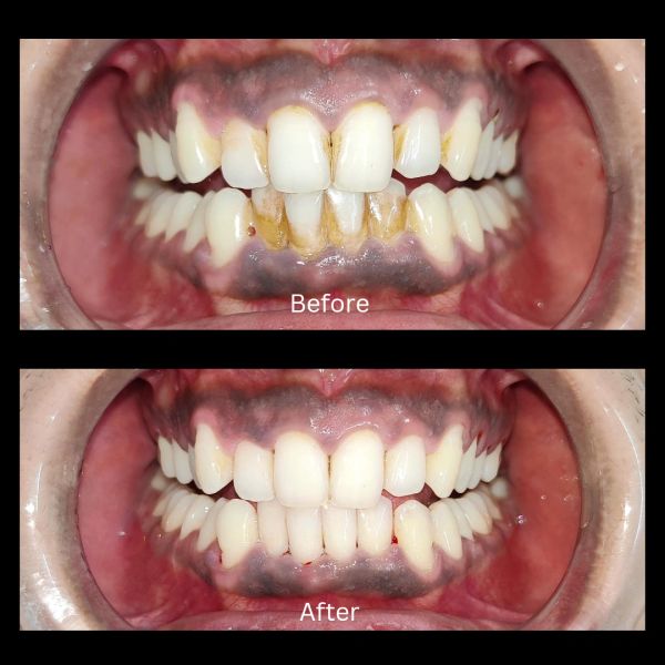 Before and after images showing dental cleaning and whitening results.