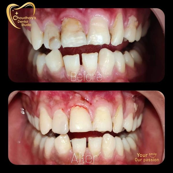 Before and after dental restoration showing improved teeth appearance.
