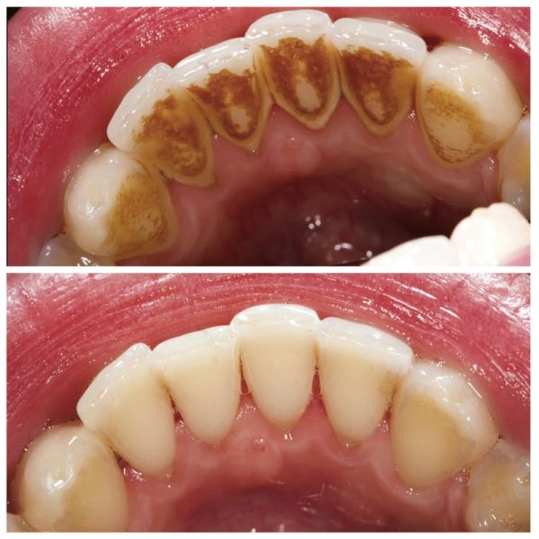 Before and after teeth cleaning showing plaque removal.
