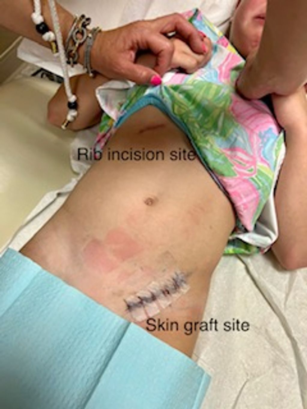 6/7/22 - Rib Incision & Skin Graft