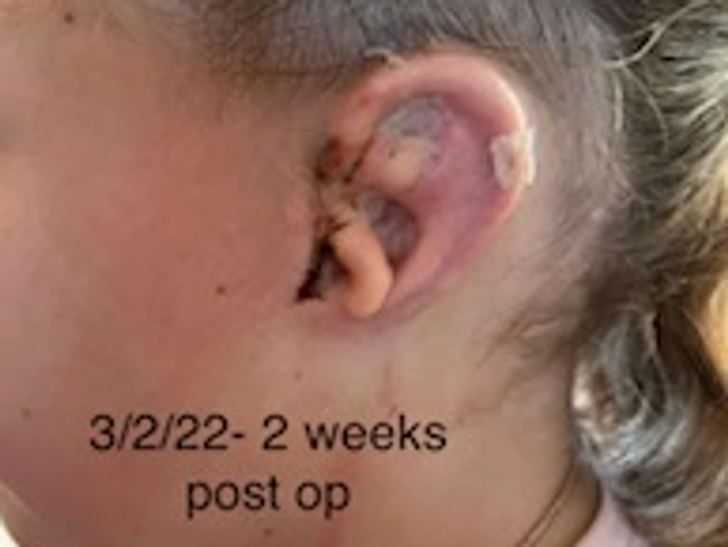 2 Weeks Post Op