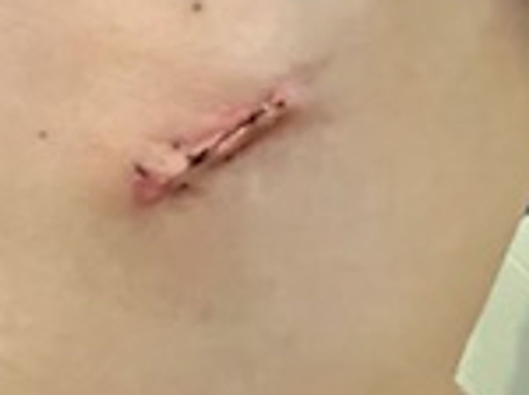 3/5/22 - Stomach Incision Nearly 3 Weeks Post Op