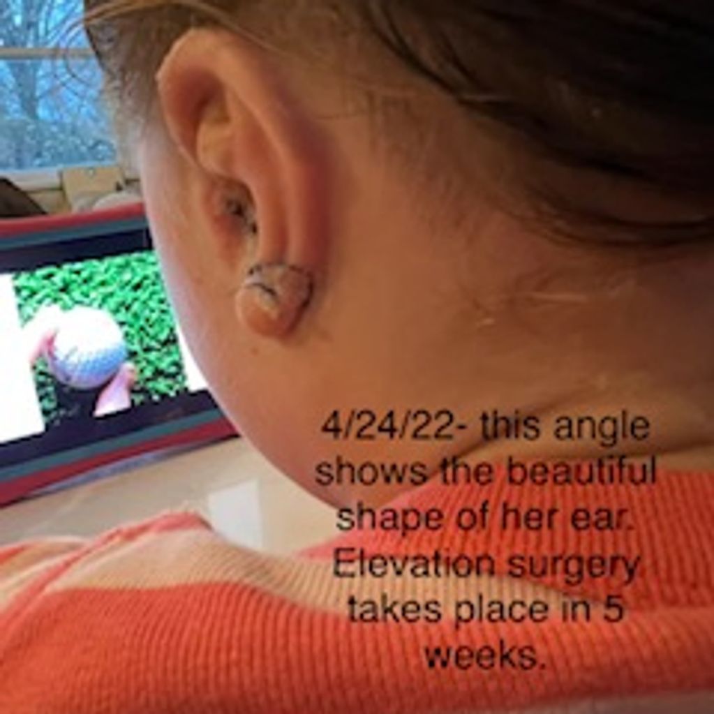 4/24/22 - 3 Weeks Post Op