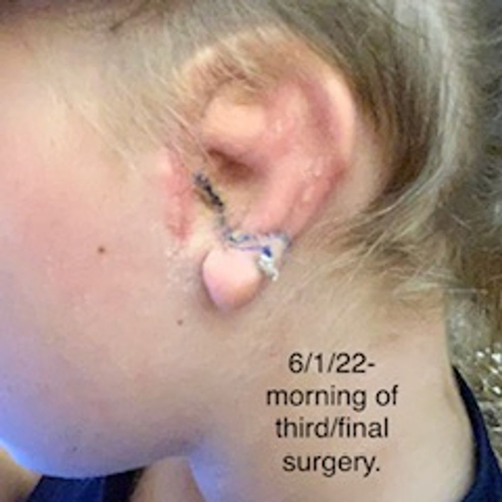 6/1/22  - Final Ear Progress Picture before Third Surgery