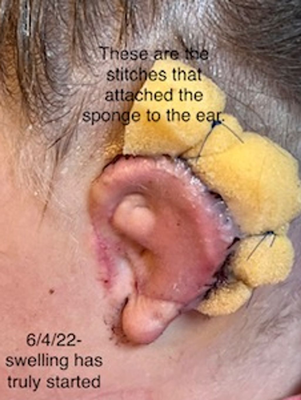 6/4/22 - Day 3 Post Op