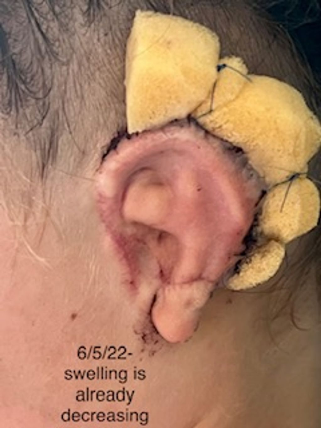 6/5/22 - 4 Days Post Op