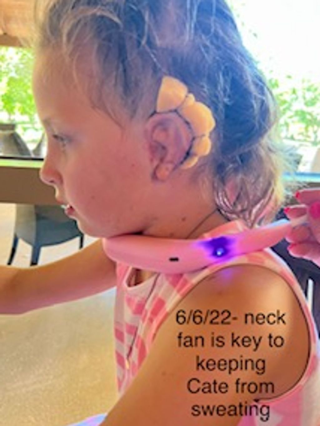 6/6/22 - 5 Days Post Op