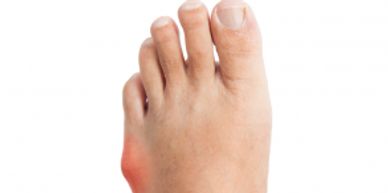 Is a bony growth from the 5th toe, can involve the joint capsule or bursa sac. Often individuals hav
