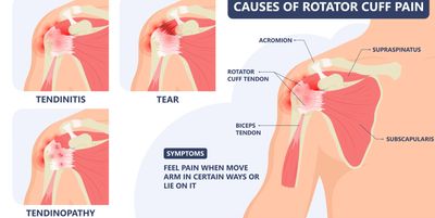 Dr David Drynan Orthopaedic Surgeon - Shoulder rotator cuff diagram for tendon tears