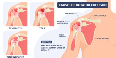 Rotator cuff tears information for Dr David Drynan - Orthopaedic surgeon