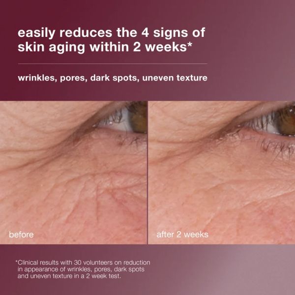Before and after close-up of eye area showing reduced wrinkles and pores.