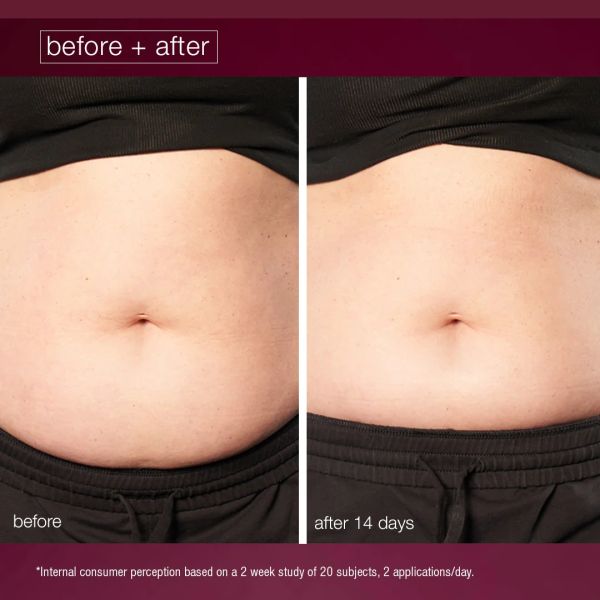 Before and after photo of a stomach after 14 days.
