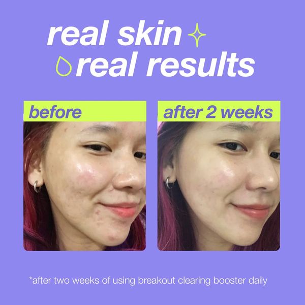 Before and after photos showing clearer skin after 2 weeks.