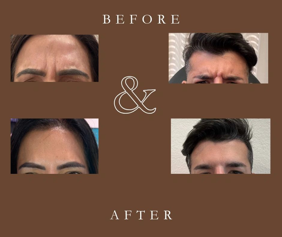 Glabella (Frown Lines) Botox