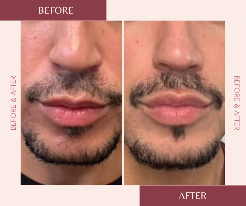 Lip Filler
Before & After – subtle, natural volume