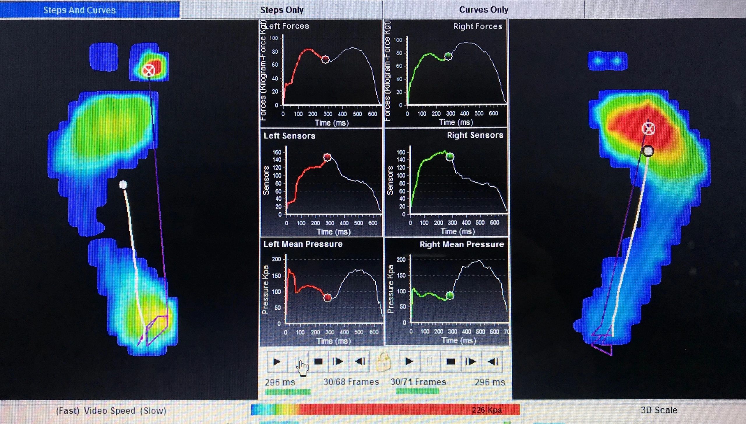 Podiatry computer gait analysis foot pressure scan sports injury rehab and prevention