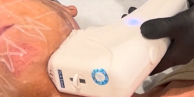Close-up of skin treatment with a handheld device.
